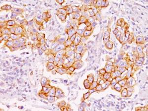 Immunohistochemical analysis of formalin-fixed, paraffin-embedded human breast carcinoma using Anti-Phosphotyrosine Antibody [PY793]