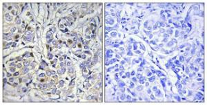 Immunohistochemical analysis of paraffin-embedded human breast carcinoma tissue using Anti-Centromeric Protein A Antibody. The right hand panel represents a negative control, where the antibody was pre-incubated with the immunising peptide.