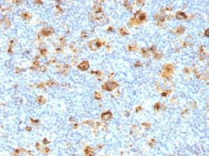 Immunohistochemical analysis of formalin-fixed, paraffin-embedded human Hodgkin's lymphoma using Anti-CD15 Antibody [MY-1]