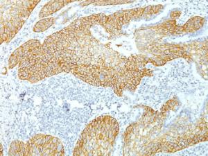 Immunohistochemical analysis of formalin-fixed, paraffin-embedded human lung squamous cell carcinoma using Anti-Desmoglein 3 Antibody [DSG3/1535]