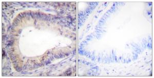 Immunohistochemical analysis of paraffin-embedded human colon carcinoma using Anti-BCL-2 (phospho Thr69) Antibody. The right hand panel represents a negative control, where the Antibody was pre-incubated with the immunising peptide