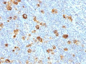 Immunohistochemical analysis of formalin-fixed, paraffin-embedded human Hodgkin's lymphoma using Anti-CD15 Antibody [FUT4/1478R]