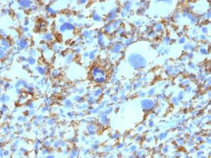 Immunohistochemical analysis of formalin-fixed, paraffin-embedded human histiocytoma using Anti-HLA DRB Antibody [SPM423]