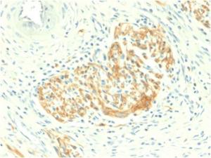 Immunohistochemical analysis of formalin-fixed, paraffin-embedded human colon carcinoma using Anti-NCAM1 Antibody [NCAM1/2217R]