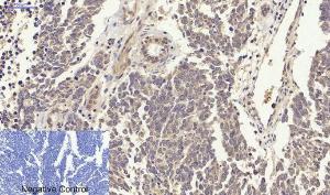 Immunohistochemical analysis of paraffin-embedded human lung cancer tissue using Anti-p38 MAPK Antibody at 1:200 (4°C overnight). Negative control was secondary antibody only