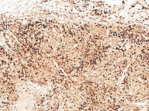 Immunohistochemistry analysis of human breast cancer, fixed in formalin and paraffin-embedded. The Primary Antibody used was Anti-GSK3 beta Antibody (A304928) at 1:50 for 30  minutes at room temperature. Counterstain: Hematoxylin. Magnification: 10X. HRP-DAB Detection