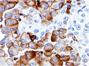 Immunohistochemical analysis of formalin-fixed, paraffin-embedded human melanoma using Anti-p75 NGF Receptor Antibody [NGFR5]