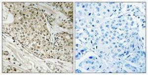 Immunohistochemical analysis of paraffin-embedded human breast cancer using Anti-Retinoblastoma Antibody 1:100 (4°C overnight). The right hand panel represents a negative control, where the antibody was pre-incubated with the immunising peptide