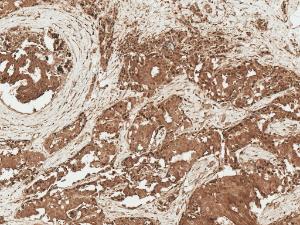 Immunohistochemistry analysis of human breast cancer, fixed in formalin and paraffin-embedded. The Primary Antibody used was Anti-AKT1 Antibody (A304932) at 1:50 for 30  minutes at room temperature. Counterstain: Hematoxylin. Magnification: 10X. HRP-DAB Detection