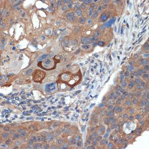 Immunohistochemistry analysis of paraffin-embedded human esophageal cancer using Anti-CRABP1 Antibody [ARC1991] (A308999) at a dilution of 1:100 (40x lens) Perform microwave antigen retrieval with 10 mM Tris/EDTA buffer pH 90 before commencing with IHC staining protocol