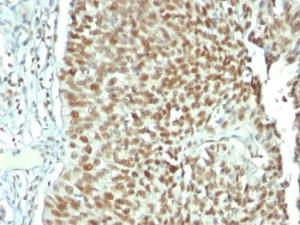 Immunohistochemical analysis of formalin-fixed, paraffin-embedded human bladder carcinoma using Anti-Nucleolin Antibody [NCL/902]