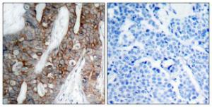 Immunohistochemical analysis of paraffin-embedded human breast carcinoma tissue using Anti-Integrin beta3 Antibody. The right hand panel represents a negative control, where the antibody was pre-incubated with the immunising peptide.