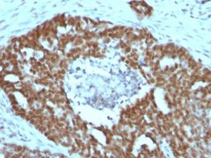 Immunohistochemical analysis of formalin-fixed, paraffin-embedded human ovarian carcinoma using Anti-Nucleolin Antibody [NCL/902]