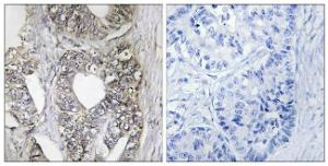 Immunohistochemical analysis of paraffin-embedded human breast carcinoma tissue using Anti-SAPK Antibody. The right hand panel represents a negative control, where the antibody was pre-incubated with the immunising peptide.