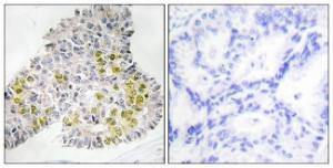 Immunohistochemical analysis of paraffin-embedded human lung carcinoma tissue using Anti-LKB1 Antibody. The right hand panel represents a negative control, where the Antibody was pre-incubated with the immunising peptide