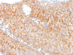 Immunohistochemical analysis of formalin-fixed, paraffin-embedded human urothelial carcinoma using Anti-SERBP1 Antibody [SERBP1/3491]