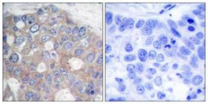 Immunohistochemical analysis of paraffin-embedded human breast carcinoma tissue using Anti-p70 S6 Kinase Antibody. The right hand panel represents a negative control, where the antibody was pre-incubated with the immunising peptide.