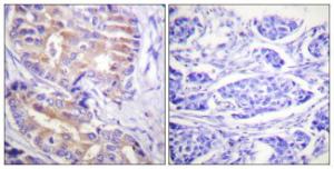 Immunohistochemical analysis of paraffin-embedded human breast carcinoma tissue using Anti-p70 S6 Kinase Antibody. The right hand panel represents a negative control, where the antibody was pre-incubated with the immunising peptide