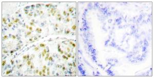 Immunohistochemical analysis of paraffin-embedded human lung carcinoma tissue using Anti-Ataxin 1 Antibody. The right hand panel represents a negative control, where the antibody was pre-incubated with the immunising peptide.