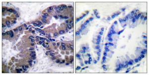 Immunohistochemical analysis of paraffin-embedded human lung carcinoma tissue using Anti-Nrf2 Antibody. The right hand panel represents a negative control, where the antibody was pre-incubated with the immunising peptide.