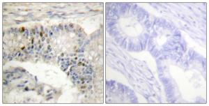 Immunohistochemical analysis of paraffin-embedded human colon carcinoma tissue using Anti-Histone H1 Antibody The right hand panel represents a negative control, where the antibody was pre-incubated with the immunising peptide