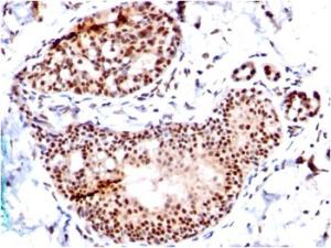 Immunohistochemical analysis of formalin-fixed, paraffin-embedded human breast carcinoma using Anti-SUMO-1 Antibody [SM1/495]