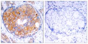 Immunohistochemical analysis of paraffin-embedded human breast carcinoma using Anti-MEK2 Antibody. The right hand panel represents a negative control, where the antibody was pre-incubated with the immunising peptide.