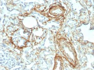 Immunohistochemical analysis of formalin-fixed, paraffin-embedded human angiosarcoma using Anti-Elastin Antibody [ELN/2069]