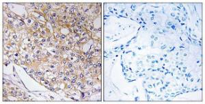 Immunohistochemical analysis of paraffin-embedded human breast carcinoma tissue using Anti-TRAPPC1 Antibody The right hand panel represents a negative control, where the antibody was pre-incubated with the immunising peptide