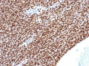 Immunohistochemical analysis of formalin-fixed, paraffin-embedded human Ewing's sarcoma using Anti-NKX2.2 Antibody [NX2/1524]