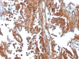 Immunohistochemical analysis of formalin-fixed, paraffin-embedded human urothelial carcinoma using Anti-SERBP1 Antibody [SERBP1/3497]