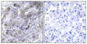 Immunohistochemical analysis of paraffin-embedded human liver carcinoma tissue using Anti-MRPS18A Antibody. The right hand panel represents a negative control, where the antibody was pre-incubated with the immunising peptide