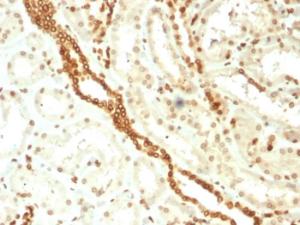 Immunohistochemical analysis of formalin-fixed, paraffin-embedded human renal cell carcinoma using Anti-Emerin Antibody [EMD/2168]