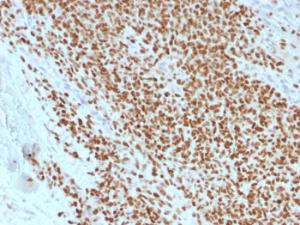 Immunohistochemical analysis of formalin-fixed, paraffin-embedded human Ewing's sarcoma using Anti-NKX22 Antibody [rNX2/1523]