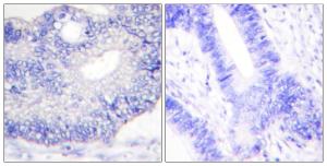 Immunohistochemical analysis of paraffin-embedded human colon carcinoma tissue using Anti-TGF alpha Antibody The right hand panel represents a negative control, where the antibody was pre-incubated with the immunising peptide