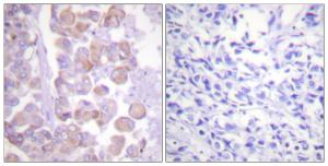 Immunohistochemical analysis of paraffin-embedded human breast carcinoma tissue using Anti-Synuclein Antibody. The right hand panel represents a negative control, where the Antibody was pre-incubated with the immunising peptide