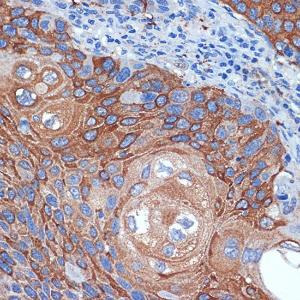 Immunohistochemistry analysis of paraffin-embedded human esophageal cancer using Anti-BPR Antibody [ARC2334] (A306086) at a dilution of 1:100 (40x lens). Perform microwave antigen retrieval with 10 mM Tris/EDTA buffer pH 9.0 before commencing with IHC staining protocol.