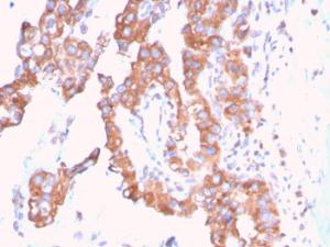 Immunohistochemical analysis of formalin-fixed, paraffin-embedded human urothelial carcinoma using Anti-SERBP1 Antibody [SERBP1/3509]