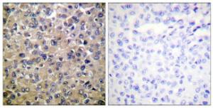 Immunohistochemical analysis of paraffin-embedded human breast carcinoma tissue using Anti-PP1-alpha Antibody. The right hand panel represents a negative control, where the antibody was pre-incubated with the immunising peptide