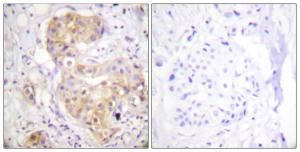 Immunohistochemical analysis of paraffin-embedded human breast carcinoma tissue using Anti-PKC delta Antibody. The right hand panel represents a negative control, where the antibody was pre-incubated with the immunising peptide