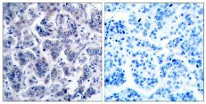 Immunohistochemical analysis of paraffin-embedded human breast carcinoma tissue using Anti-TYK2 Antibody. The right hand panel represents a negative control, where the antibody was pre-incubated with the immunising peptide