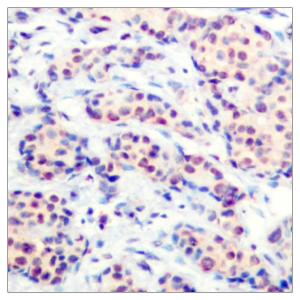 Immunohistochemical analysis of paraffin-embedded human breast carcinoma tissue using Anti-JunD Antibody. The right hand panel represents a negative control, where the antibody was pre-incubated with the immunising peptide.