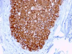 Immunohistochemical analysis of formalin-fixed, paraffin-embedded human breast carcinoma using Anti-HER2 Antibody [ERBB2/3078]