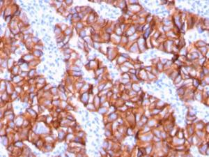 Immunohistochemical analysis of formalin-fixed, paraffin-embedded human breast carcinoma using Anti-HER2 Antibody [ERBB2/3078]