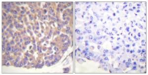 Immunohistochemical analysis of paraffin-embedded human breast carcinoma tissue using Anti-Fila min A Antibody. The right hand panel represents a negative control, where the Antibody was pre-incubated with the immunising peptide