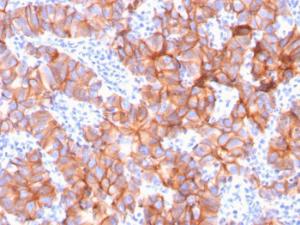 Immunohistochemical analysis of formalin-fixed, paraffin-embedded human breast carcinoma using Anti-HER2 Antibody [ERBB2/3079]