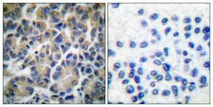 Immunohistochemical analysis of paraffin-embedded human breast cancer using Anti-Fila min A Antibody 1:100 (4 °C overnight). The right hand panel represents a negative control, where the Antibody was pre-incubated with the immunising peptide