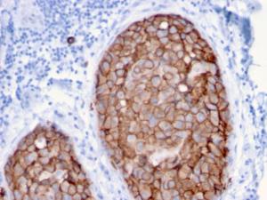 Immunohistochemical analysis of formalin-fixed, paraffin-embedded human breast carcinoma using Anti-HER2 Antibody [ERBB2/3079]