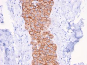 Immunohistochemical analysis of formalin-fixed, paraffin-embedded human breast carcinoma using Anti-HER2 Antibody [ERBB2/3079]