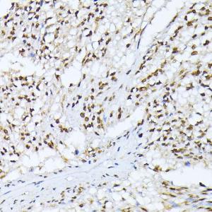 Immunohistochemistry analysis of paraffin-embedded human gastric cancer using Anti-CSNK2A1 Antibody (A307776) at a dilution of 1:100 (40x lens). Perform microwave antigen retrieval with 10 mM PBS buffer pH 7.2 before commencing with IHC staining protocol.